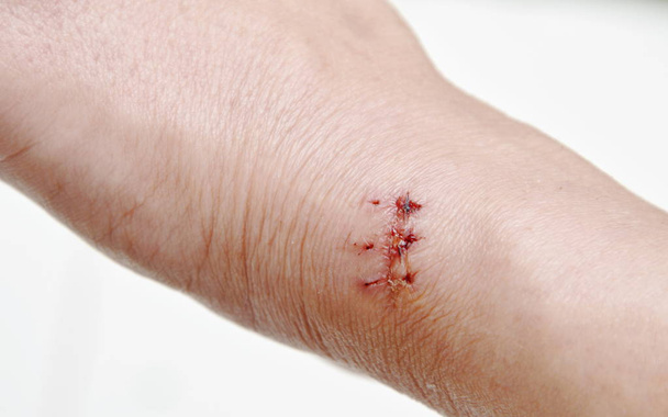  main avec cicatrice de suture après la chirurgie sur fond blanc
 - Photo, image