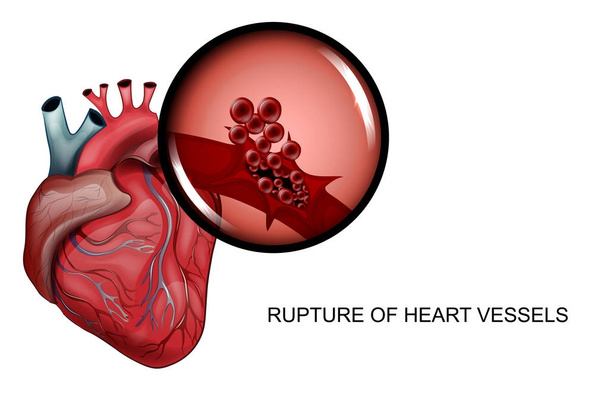rupture of blood vessels of the heart - Vector, Image