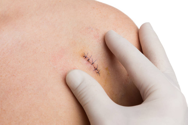 Manos médicas o enfermeras examinando sutura fresca en el hombro de la mujer
 - Foto, imagen