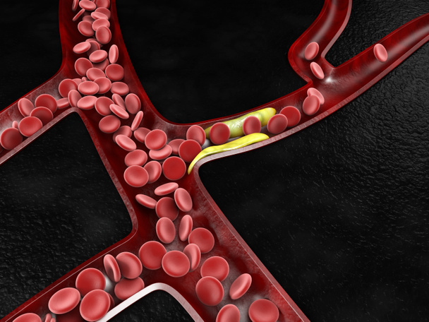 3d Ilustração de células sanguíneas com acúmulo de placa de colesterol
 - Foto, Imagem