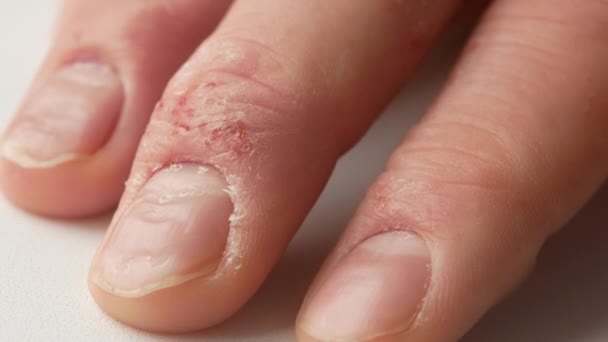 Close-up of a mans fingers suffering from psoriasis. Eczema on the hands - Záběry, video