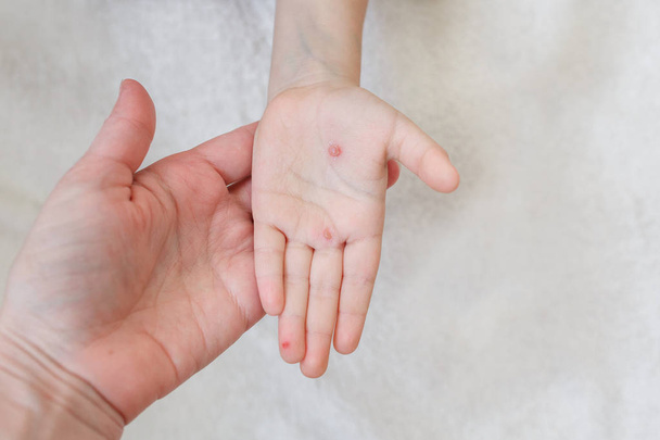 La mano de un niño con varicela en la mano de su madre. Ampollas en la mano por varicela
 - Foto, imagen