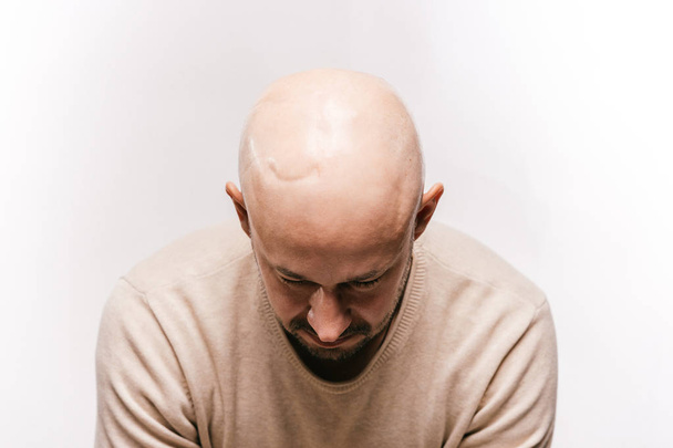 Bald man psychological stress struggling for life arter brain tumor. Heartbreaking male emotions after cancer neurosurgery operation. Oncology survivor patient. Chemotherapy and irradiation head marks - Foto, Bild