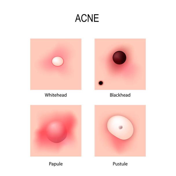 Acne vulgaris. stages of development. Types of pimples. - Vector, Image