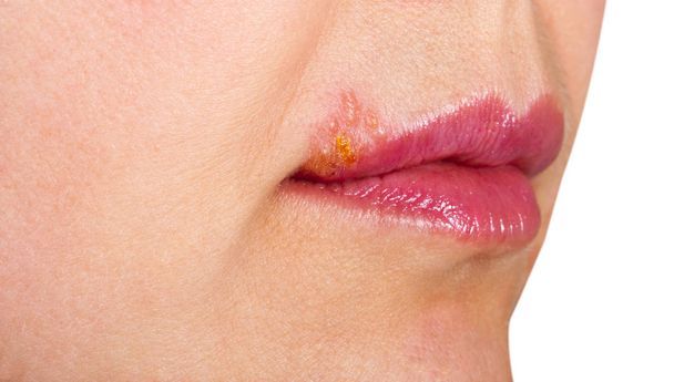Herpes auf der Lippe Nahaufnahme Makro - Foto, Bild