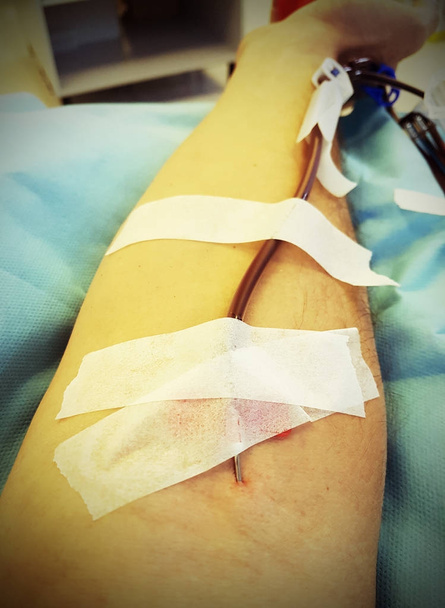 Blood Donor met de chirurgische naald vast te zitten in het vlees met vin - Foto, afbeelding