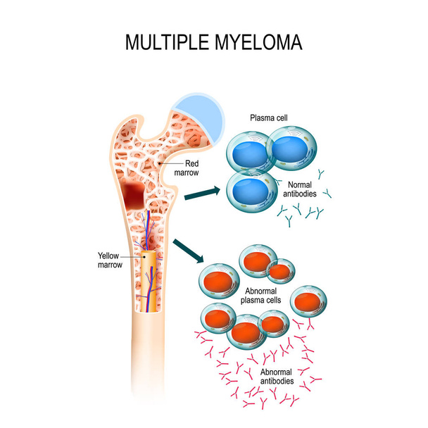 Multiple myeloma. plasma cell myeloma - Vector, Image
