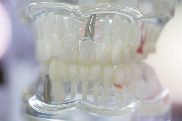 Impianti dentali, modelli di formazione
 - Foto, immagini