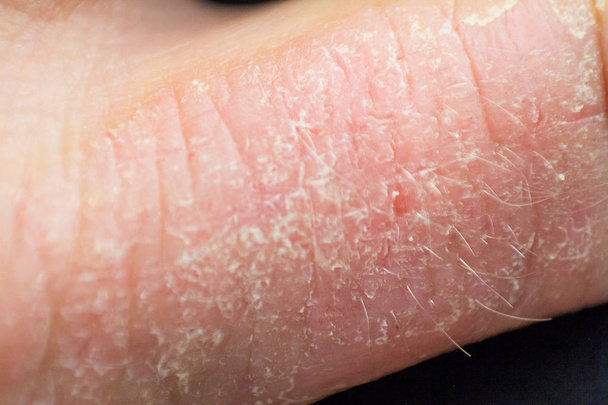 Dermatite das mãos. eczema da mão
 - Foto, Imagem