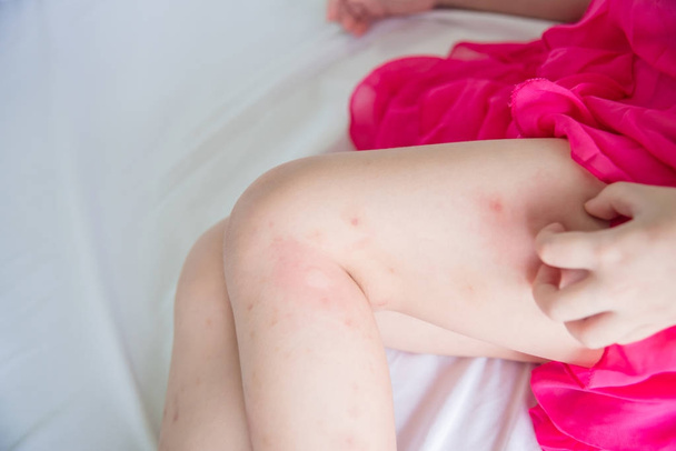Beine mit Schwellung durch Mückenstiche  - Foto, Bild