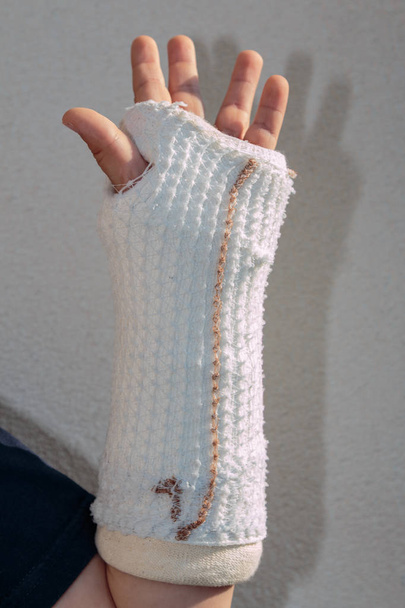 Сломанная рука в гипсе маленького белого мальчика
 - Фото, изображение