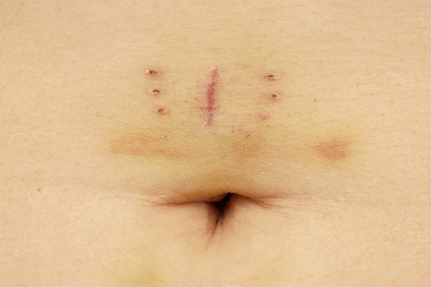 Шрам с синяком и пупок крупным планом после гистерэктомии
 - Фото, изображение