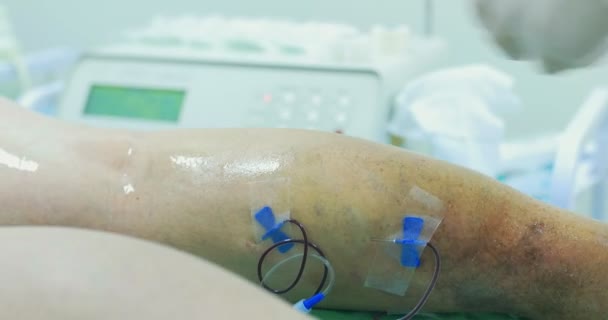 Paciente anciana pierna: trombosis, araña venosa, varices. Antes de la operación
 - Imágenes, Vídeo