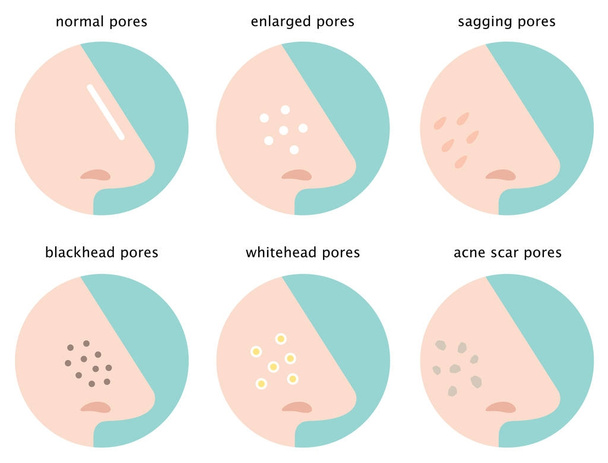 serie di pori della pelle sul naso: normale, cascante, ingrandito, blackhead, whitehead e cicatrice dell'acne
 - Vettoriali, immagini