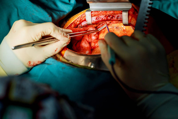 Açık kalp ameliyatı sırasında ekip çalışması cerrahlar - Fotoğraf, Görsel