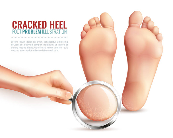 Cracked Heels Illustration - Vector, Image