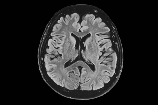 Ανθρώπινος εγκέφαλος μαγνητική τομογραφία, αξονική όψη - Φωτογραφία, εικόνα