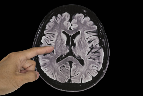 Ανθρώπινος εγκέφαλος μαγνητική τομογραφία, αξονική όψη - Φωτογραφία, εικόνα