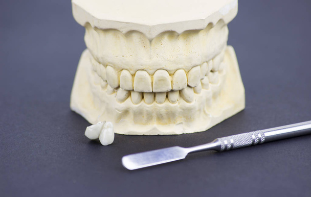 Tandheelkundige molding ter illustratie van de tandheelkundige industrie en tandheelkundige implantologie - Foto, afbeelding