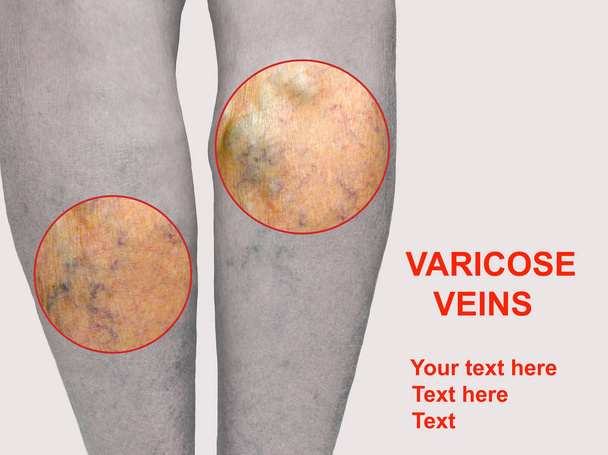 Painful varicose veins,,spider veins, varices on a severely affected leg. Ageing, old age disease, aesthetic problem concept. - Photo, Image