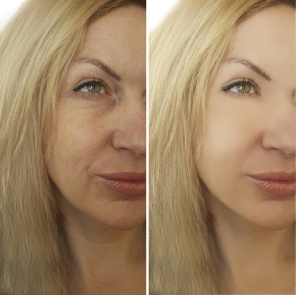 arrugas en la cara antes y después
 - Foto, Imagen