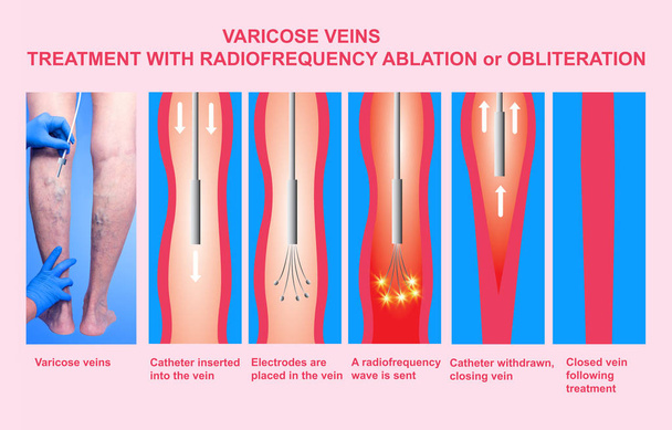 Varicose Veins and Treatment with radiofrequency ablation - Photo, Image