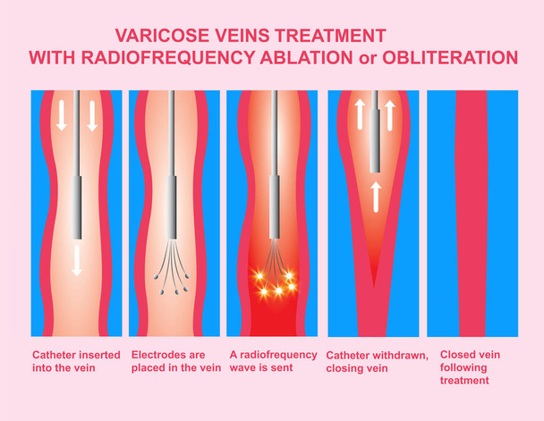 Varicose Veins and Treatment with radiofrequency ablation - Photo, Image