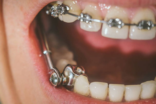 Braces and dental appliance for deep bite - Photo, Image