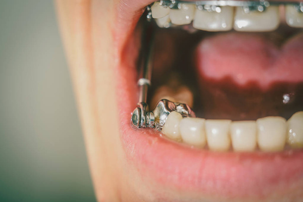 Diş telleri ve derin ısırık için diş cihaz - Fotoğraf, Görsel