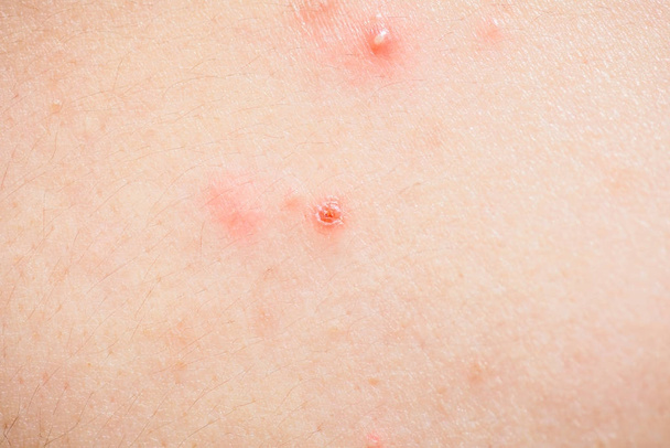 Health problem, closeup young girl acne on her back. - Photo, Image