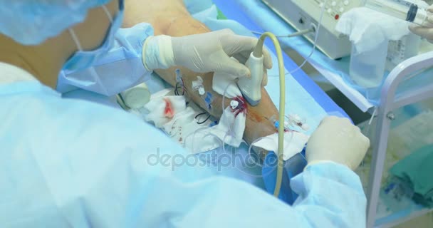 Πρωτοποριακή μέθοδος χειρουργικής φλεβίτιδα, σκληροθεραπεία διαδικασία. Γκρο πλαν βολή των ποδιών του ασθενούς - Πλάνα, βίντεο