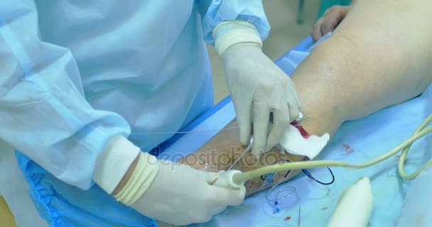 Інноваційний метод хірургії варикозного розширення вен, процедура склеротерапії. Крупним планом знімок ніг пацієнта
 - Кадри, відео