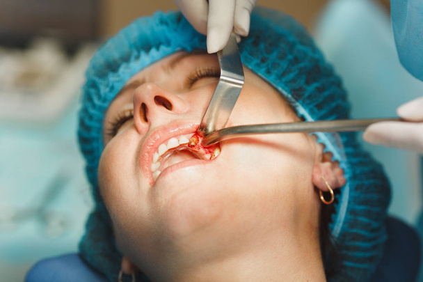 Εσωτερικη διαδικασία αρσενικό επαγγελματία οδοντίατρο χειρούργο εκτέλεση λειτουργίας εγκατάσταση οδοντικό εμφύτευμα τα δόντια του ασθενούς γυναίκας σε κλινική φως γραφείο με σύγχρονα εργαλεία εξοπλισμού. Αίμα και πόνος στο πρόσωπο. - Φωτογραφία, εικόνα