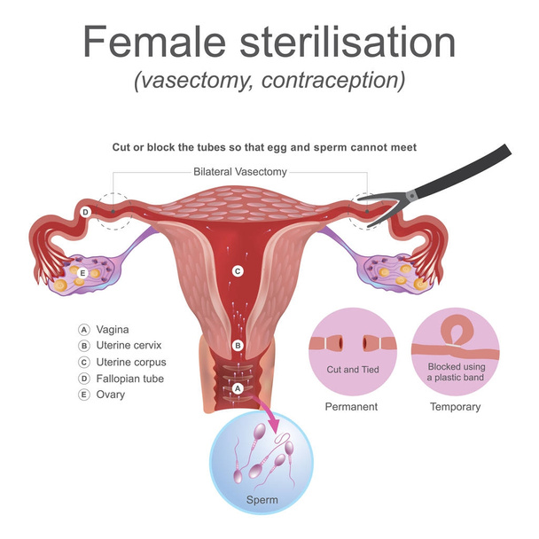 Vrouwelijke sterilisatie vasectomie. De mannelijke reproductieve systeem deze werken samen voor de productie van sperma. - Vector, afbeelding
