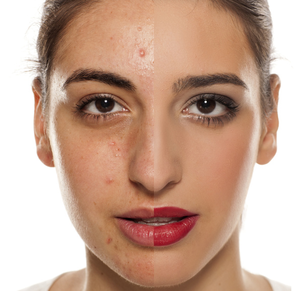 Vertaileva muotokuva naiskasvoista, joilla on ongelmallinen iho, ennen ja jälkeen meikin
 - Valokuva, kuva