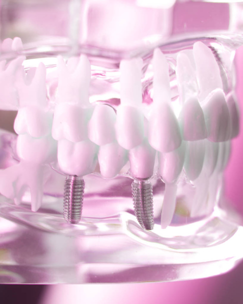 Dentsts dental tooth implantaat - Foto, afbeelding