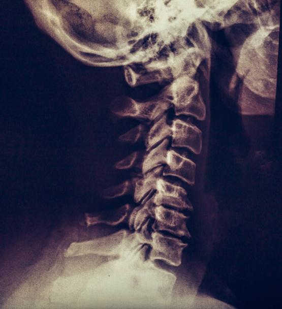 Radiografia del collo, della vertebra o della colonna vertebrale umana
 - Foto, immagini