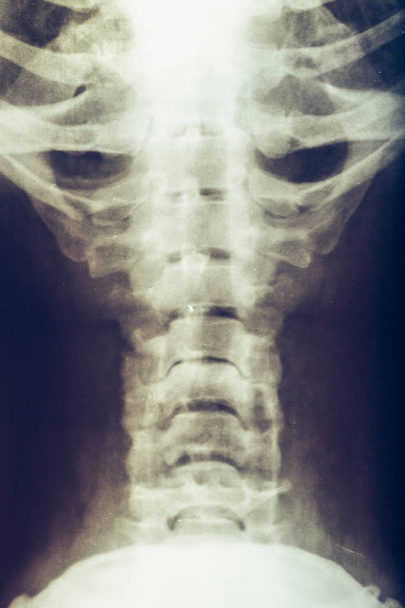 人間の首、脊椎や脊椎の x 線 - 写真・画像