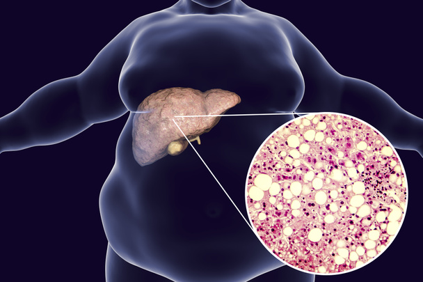 Obese man with fatty liver - Photo, Image