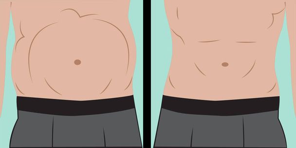Hinchazón abdominal en el estómago humano
  - Vector, Imagen