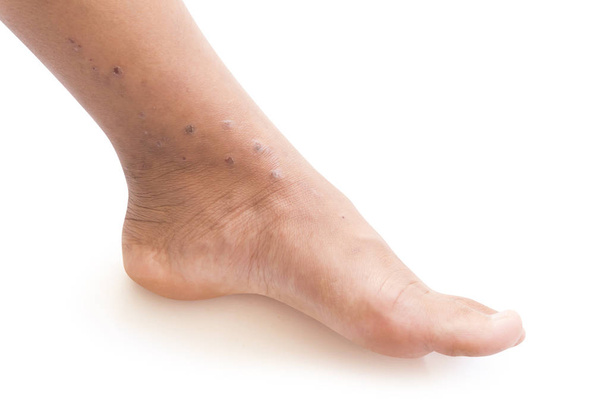 Nainen jalka ongelmallinen iho ja arvet valkoisella taustalla, terveydenhuollon käsite
 - Valokuva, kuva