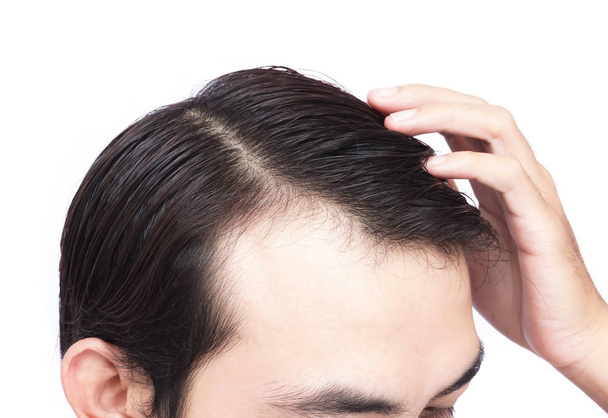 Junger Mann ernstes Haarausfall-Problem für Gesundheitswesen medizinisches und Shampoo-Produktkonzept - Foto, Bild