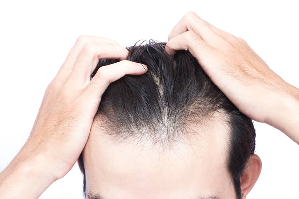 Fiatal férfi súlyos hajhullás probléma az egészségügyi ellátás orvosi és sampon termék koncepció - Fotó, kép