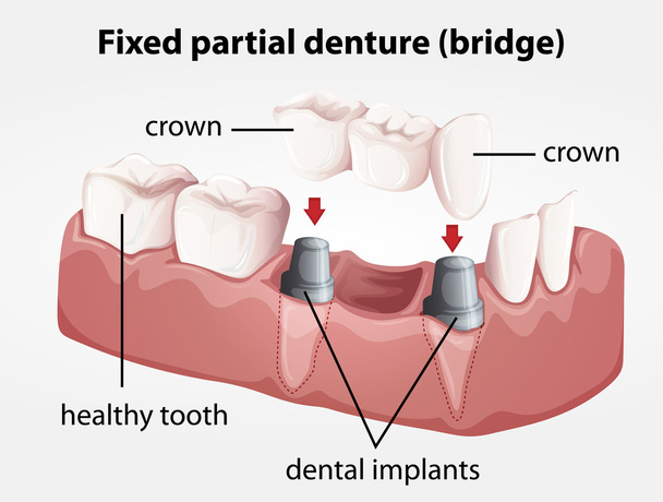 pevná Částečná zubní protéza most - Vektor, obrázek