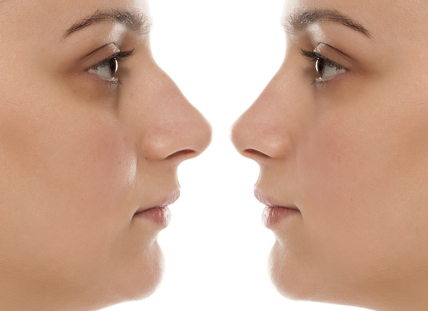 Retrato comparativo de uma mulher jovem antes e depois da cirurgia nasal
 - Foto, Imagem