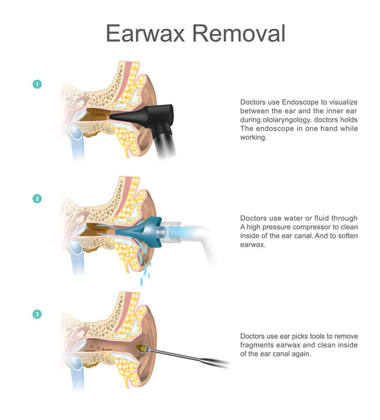 Удаление ушной серы. EARWAX s a common problem which is easy treate
 - Вектор,изображение