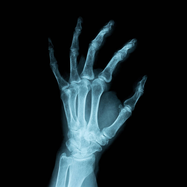 Εικόνα ακτινογραφία των ένα ανθρώπινο χέρι αριστερά - Φωτογραφία, εικόνα