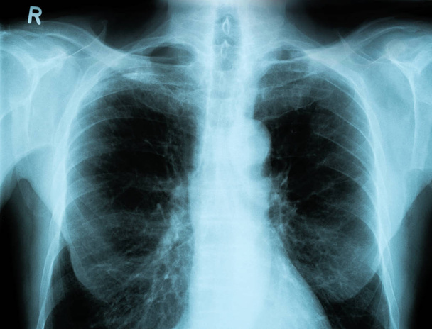 X-Ray Image Of Human Chest - Photo, Image