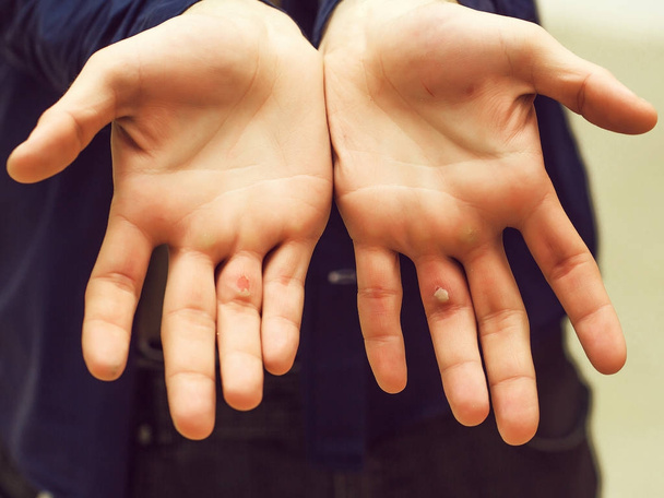 Handen met blister en eelt - Foto, afbeelding