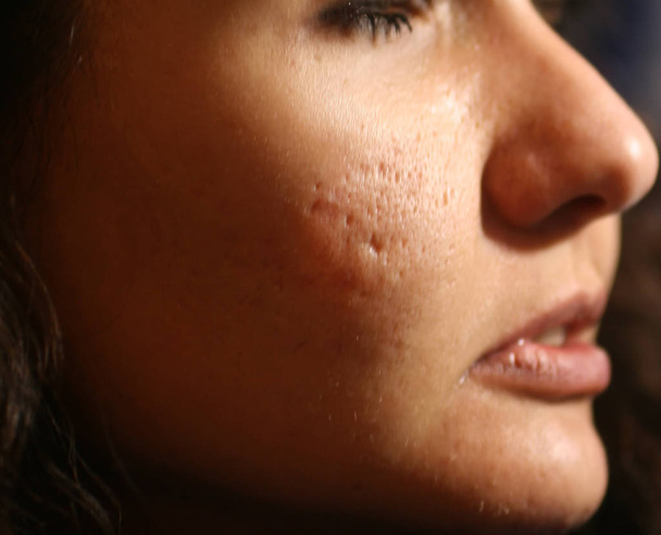 Pelle infiammata del viso nei brufoli e nell'acne. Cicatrici cheloidi da acne
 - Foto, immagini